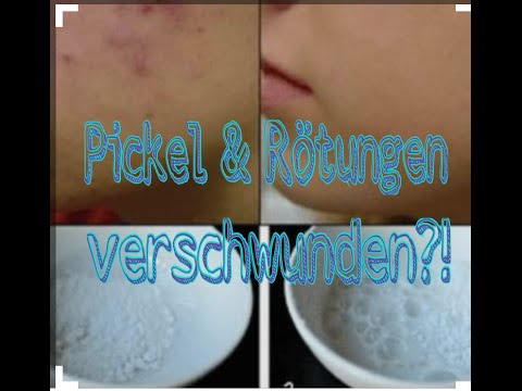 Pickelfrei durch Wasser &amp; Backpulver?!